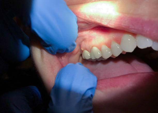 Best Knocked-Out Tooth (Avulsed Tooth) Treatment in Garrett, IN